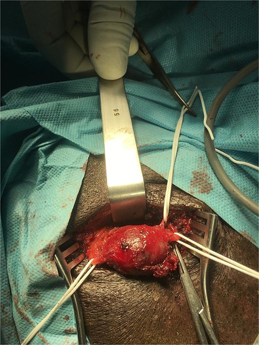 Intraoperative view of the right facial artery aneurysm and its multiple collaterals.