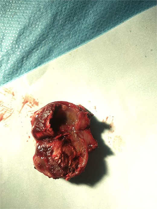 Cross-section of the removed aneurysm.