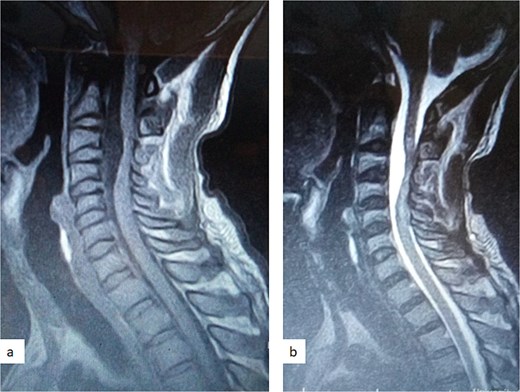 Sagittal T1-weighted (a) and T2-weighted (b) cervical spine MRI images showing an intradural arachnoid cyst posteriorly displacing and compressing the spinal cord.