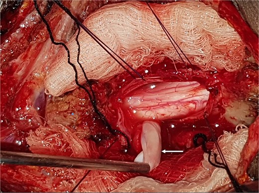 Intra-operative photograph showing complete excision of the arachnoid cyst in Fig. 1.