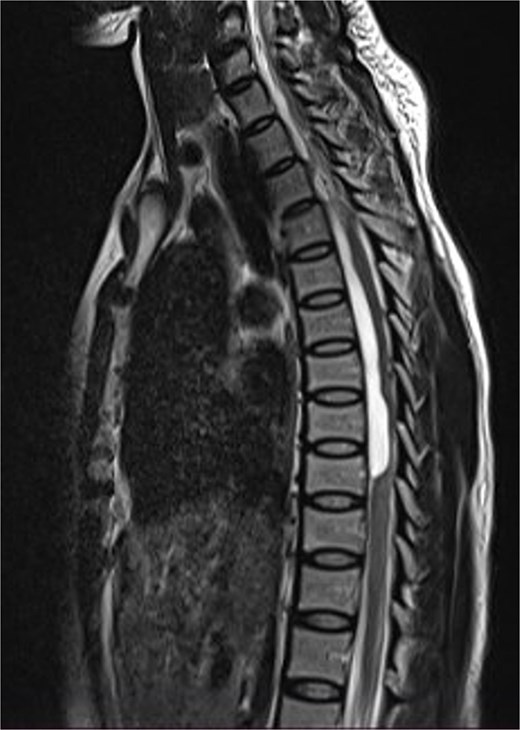 Sagittal T2-weighted thoracic spine MRI images showing an anteriorly located intradural arachnoid cyst at T5–T9, posteriorly displacing and compressing the spinal cord.