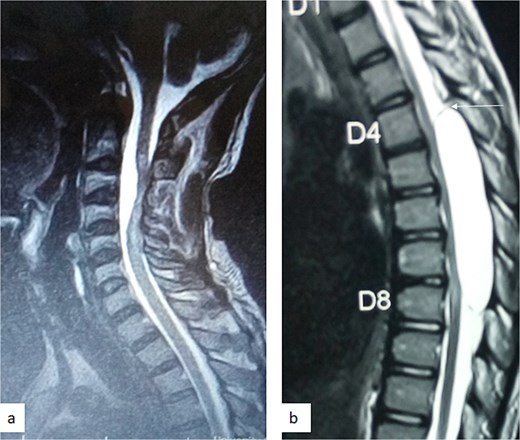 (a) Sagittal T2-weighted cervical spine MRI image showing expanded subarachnoid space anterior to the spinal cord at C2–C4, posterior displacement and compression of the cord and cord signal change at C2–C5. The wall of the cyst is indistinguishable suggestive of intradural spinal arachnoid cyst. (b) Sagittal T2-weighted thoracic MRI image showing compression of the spinal cord anteriorly. There is visible hypointense cyst wall (arrow) suggestive of extradural cyst.