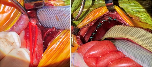 Note (left) the vessel loop around the GE junction in a Potts fashion. This was performed first, followed by CDH repair (right), and then placing a gastrostomy to water seal in the first surgery. Note (right) the distention of the bowels from air shunted through the fistula prior to control of the fistula. After CDH repair and gastrostomy, the vessel loop was loosened and loosely brought out the upper part of the incision at closure and secured.
