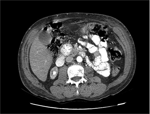 Triphasic computed tomography of the pancreas, arterial phase, showing a tumor in the head of the pancreas.