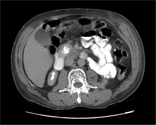 Triphasic computed tomography of the pancreas, late phase, showing a tumor in the head of the pancreas.