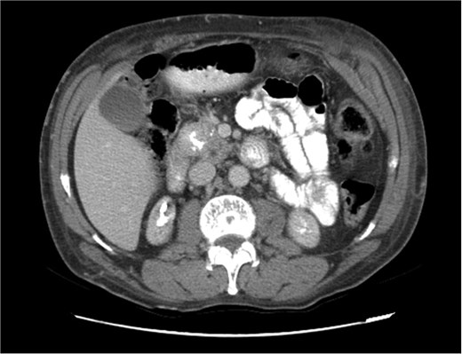 Triphasic computed tomography of the pancreas, portal phase, showing a tumor in the head of the pancreas.