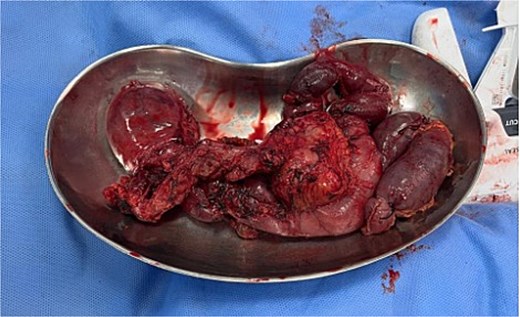 Surgical specimen.
