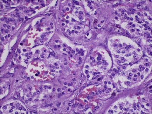 Hematoxylin and eosin (H&E) stain, 400× magnification. Tumor cells arranged in nested and trabecular patterns with round, hyperchromatic nuclei, and finely granular chromatin.