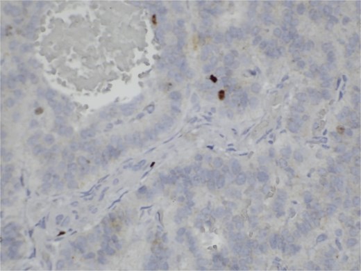 Immunohistochemistry for Ki-67. Scattered nuclear staining is observed, indicating a low proliferative index (2%).