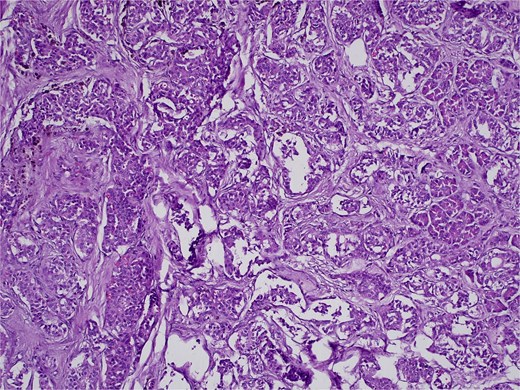 H&E stain, 100× magnification. Diffuse infiltration of pancreatic parenchyma by tumor cells with desmoplastic stroma.