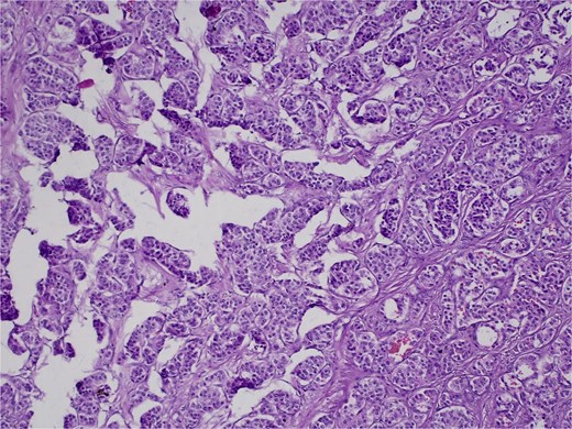 H&E stain, 100× magnification. Irregular clusters of neoplastic cells with vascular invasion.