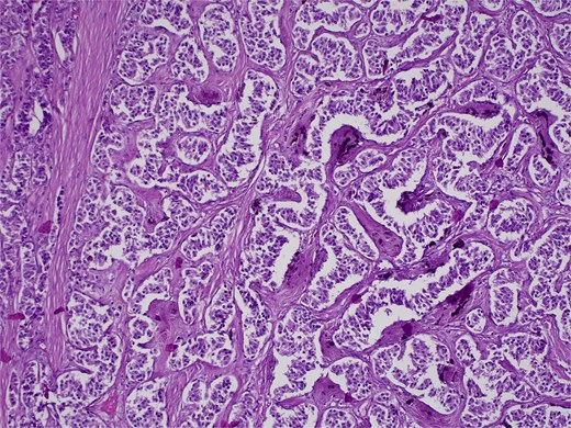 H&E stain, 100× magnification. Papillary and trabecular architecture with minimal atypia and characteristic “salt and pepper” chromatin.