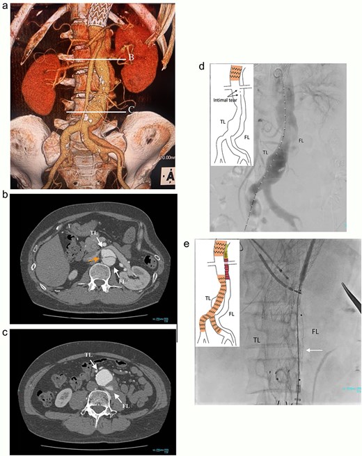 Preoperative CT 3D reconstruction showing the FL extended from the descending aorta to the external iliac artery (a), contrast-enhanced CT axial images at the renal artery level with an intimal tear (b; arrow), and the abdominal aortic aneurysm level (c), and the intraoperative angiography showing the FL were contrasted through intimal tear at the visceral segment (d), Endurant II iliac leg placed in the FL closing intimal tears near the renal artery (e; white arrow). TL: true lumen; FL: false lumen.
