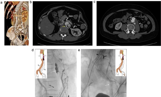 The contrasted CT 3D reconstruction 2 years after the false lumen (FL) stent graft placement (a; white arrow); the contrast-enhanced CT axial images showing small inflow to the FL from the true lumen through the gap between the intimal tear and the FL stent graft (b; arrow), and abdominal aortic aneurysm expansion to 56 mm (c; white arrow); the intraoperative angiography showing coiling of the gap between the intimal tear and FL stent graft (d; white arrow), and the VBX was deployed at left external iliac artery covering the re-entry tear (e; white arrow). TL: true lumen; FL: false lumen; SMA: superior mesenteric artery.