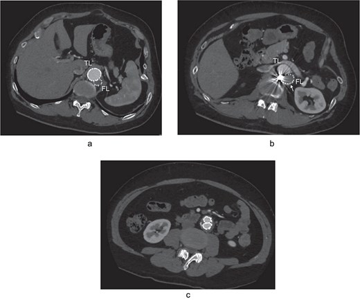 The postoperative contrast-enhanced CT axial images 3 years after the procedure showed no contrast inflow into the FL, and the reduced diameter of post-dissection thoracoabdominal aortic aneurysm at thoracic level (a), renal artery level with FL stent graft (b; white arrow), and abdominal level (c). TL: true lumen; FL: false lumen.