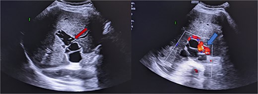 Ultrasound images reveal the presence of multiple liquid cystic formations that do not respond to colour Doppler in the lumen of the portal trunk and its dividing branches. These findings are in relation to portal hydatidosis, with the development of a portal cavernoma.