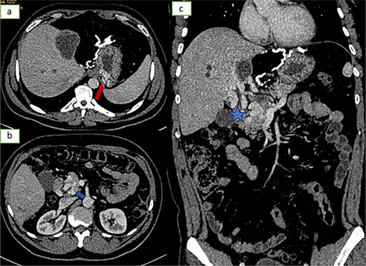 Axial sections (a and b) and coronal reconstruction (c) of an injected abdominopelvic scan showing signs of portal hypertension: gastric varices, peripancreatic varices.