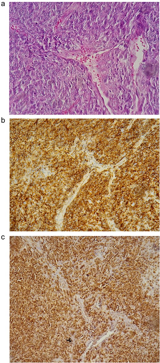 (a) Histological findings; (b) positivity of the CD34 marker; (c) positivity of STAT6.