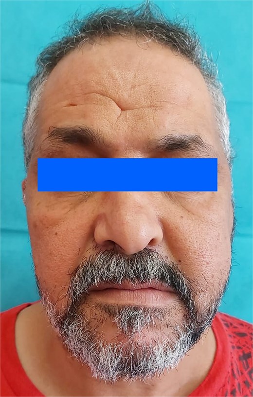 Front view of the patient’s left hemifacial swelling.