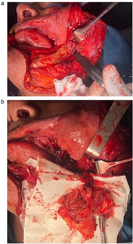 Intraoperative aspect of the tumor before excision (a) and after excision (b).