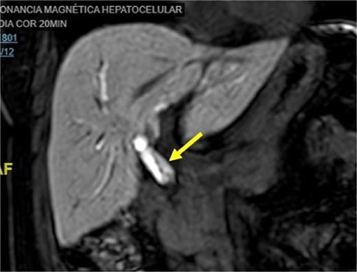 Magnetic resonance cholangiopancreatography image common bile duct intraductal tumor, coronal view.