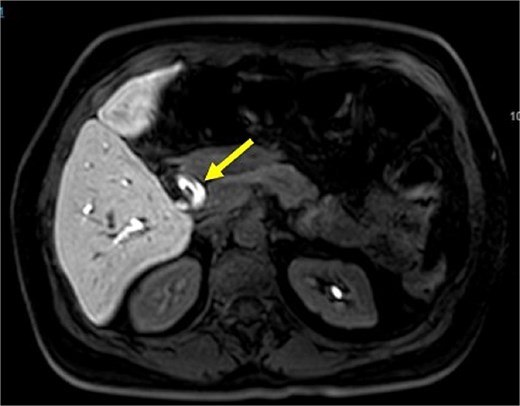 Magnetic resonance cholangiopancreatography image common bile duct intraductal tumor, axial view.