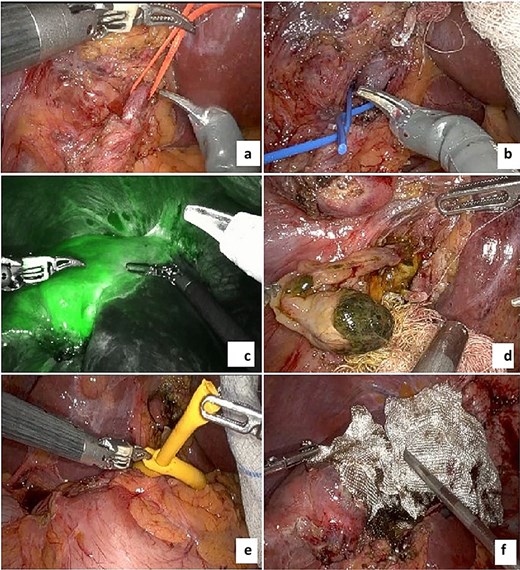 Images of the procedure. (a) Left hepatic artery; (b) left portal vein; (c) indocyanine green ischemic demarcation before liver transection; (d) intraductal pedunculated solid mass; (e) Pringle maneuver using Foley catheter; (f) final transection with hemostatic material.