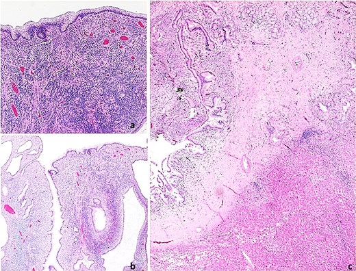 Histopathological images. Mucinous cystic neoplasm of the liver. (a) Neoplasm with a thick fibrous pedicle anchored in the hepatic parenchyma; (b) Multilocular neoplasm with compact cellular stroma; (c) Mucin-producing columnar epithelial lining and underlying ovarian-type hypercellular stroma.