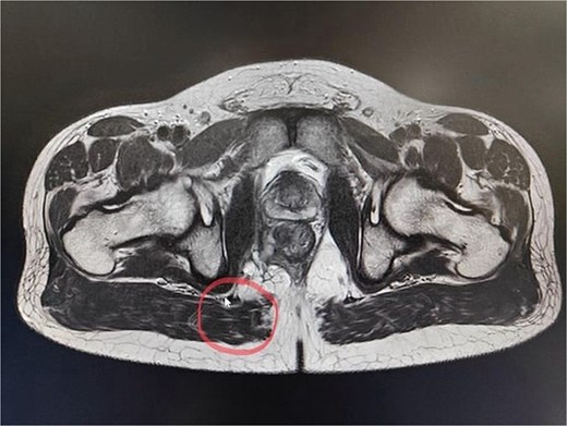 A possible fistulous tract was observed in the right perianal region, with a distal blind end in the intergluteal cleft. The fistulous tract does not involve the anal sphincter complex/levator ani muscle.