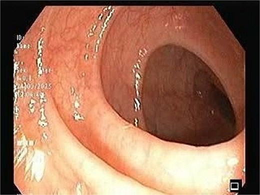 The image depicting normal colonic mucosa up to caecum with normal vascular pattern.