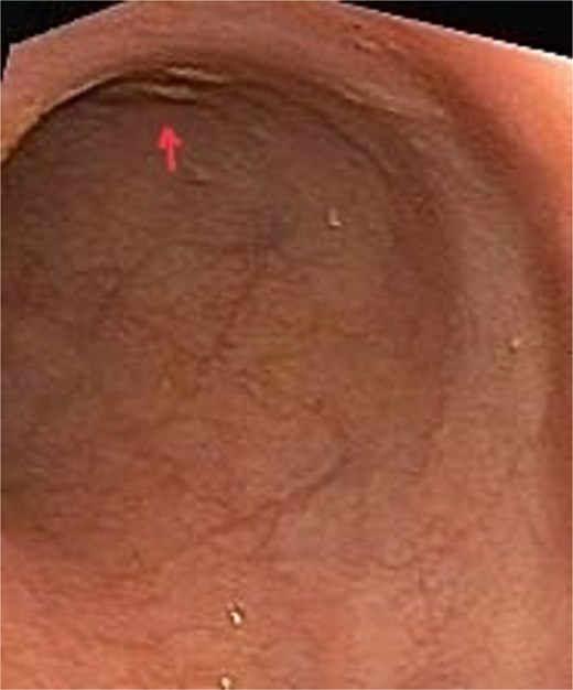Picture depicting normal rectal mucosa with few tiny erosions.