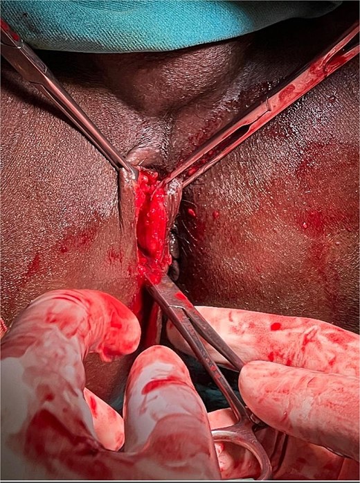 Intraoperative picture depicting excision and biopsy via perianal route.