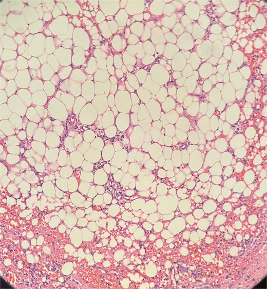Picture depicting evidence of fat necrosis in the excised perianal tissue.