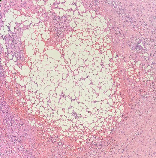 Sections show a dense inflammatory infiltrate within the subcutaneous adipose tissue, consistent with panniculitis. The infiltrate is composed of neutrophils, lymphocytes, plasma cells, and histiocytes.