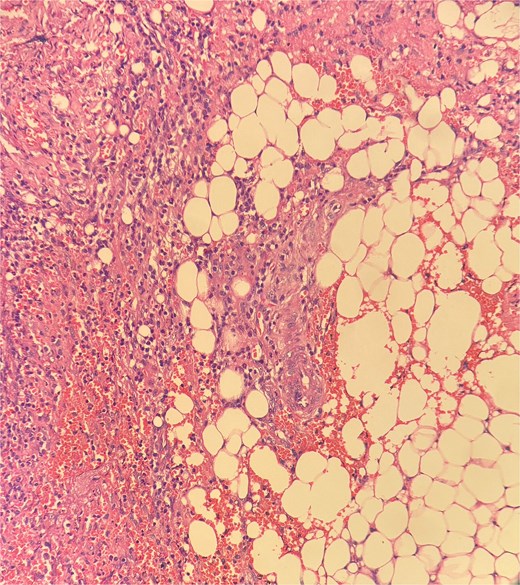 Histopathological examination showed ghost-like adipocytes and foamy histiocytes.