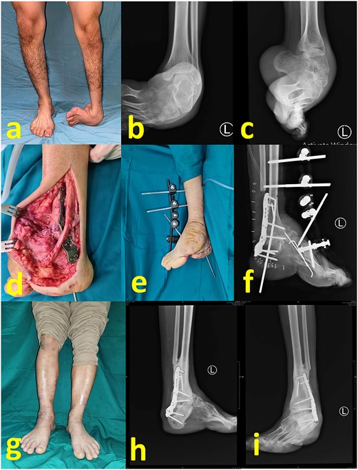 (a) Preoperative clinical images; (b) and (c) preoperative radiograph; (d) intraoperative image after partial talectomy followed by fixation with plate and screw; (e) immediate postoperative image depicting additional fixation with Schanz screw and external fixator; (f) immediate postoperative radiograph; (g) latest clinical images after 1 year postoperative; (h) and (i) latest radiograph after 1 year postoperative.
