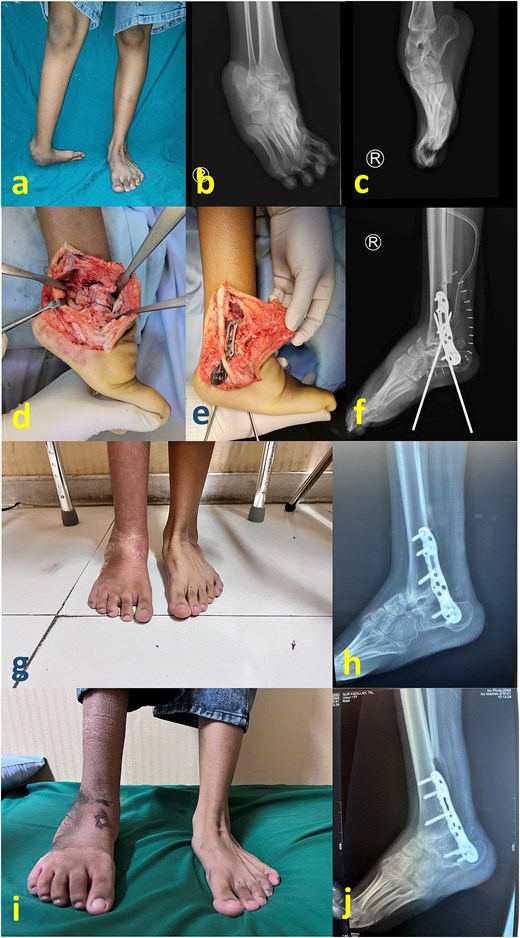 (a) Preoperative clinical images; (b) and (c) preoperative radiograph; (d) intraoperative image after partial talectomy followed by (e) fixation with plate and screw; (f) immediate postoperative image depicting additional fixation with Schanz screw; (g) clinical images at 2 months postoperative (h) 2 months postoperative radiograph; (i) latest clinical images after 1 year postoperative; (j) latest radiograph after 1 year postoperative showing healed arthrodesis.