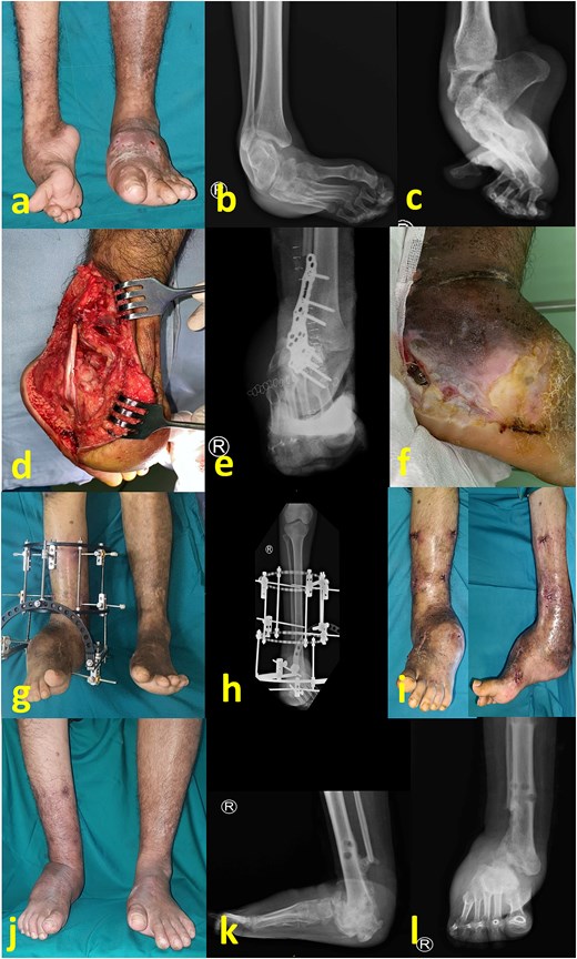 (a) Preoperative clinical image; (b) and (c) preoperative radiograph; (d) intraoperative image after partial talectomy; (e) immediate postoperative radiograph; (f) clinical image after 1 month, showing wound breakdown and loss of fixation; (g) clinical images after reoperation consisted of plate removal, debridement, reduction, and fixation with Ilizarov frame; (h) immediate radiograph after second surgery; (i) clinical image after frame removal at 2 months postoperative; (j) latest follow up image showing stable plantigrade ankle despite a persistent bulk at lateral foot; (k) and (l) latest radiograph at 1 year after first surgery, showing healed arthrodesis.