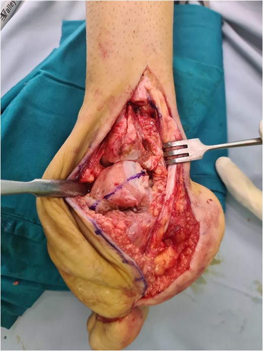 Intraoperative image of partial talectomy cut.