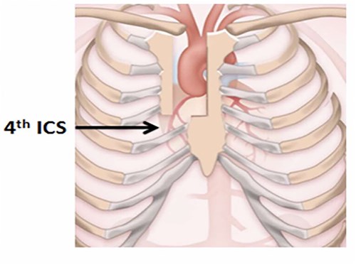 Upper hemisternotomy incision.