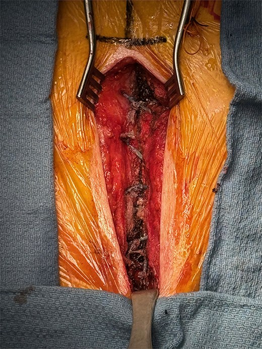 Upper hemisternotomy closure with FiberTape.