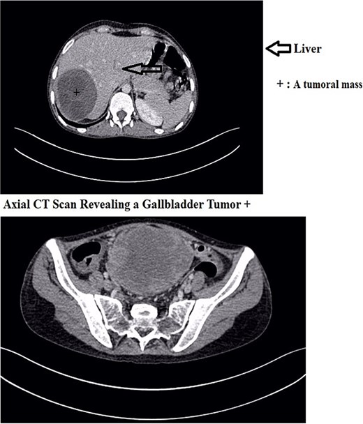 Axial CT scan revealing a gallbladder tumor with invasion of adjacent structures.