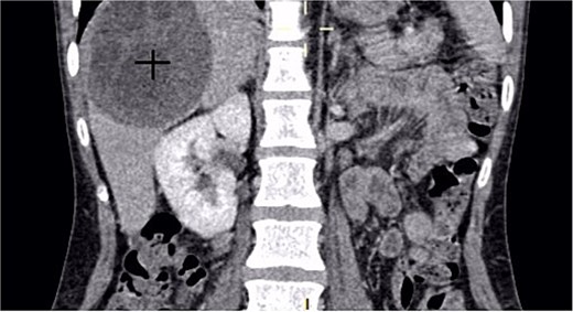 A coronal CT scan of the abdomen showing a large, well-defined hypodense mass in the right hepatic lobe.