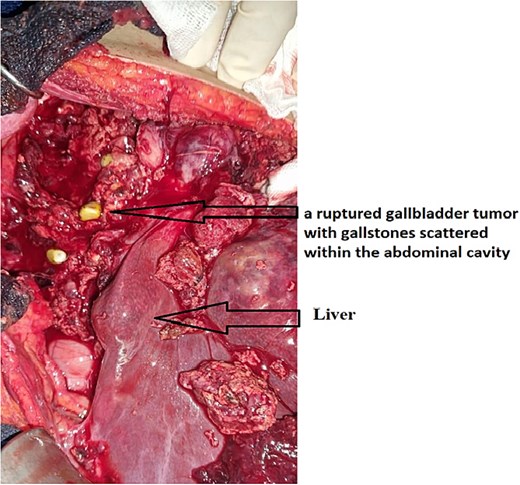 Intraoperative image showing a ruptured gallbladder tumor with gallstones scattered within the abdominal cavity. The tumor exhibits extensive invasion of adjacent tissues, emphasizing the aggressive nature of undifferentiated gallbladder carcinoma.
