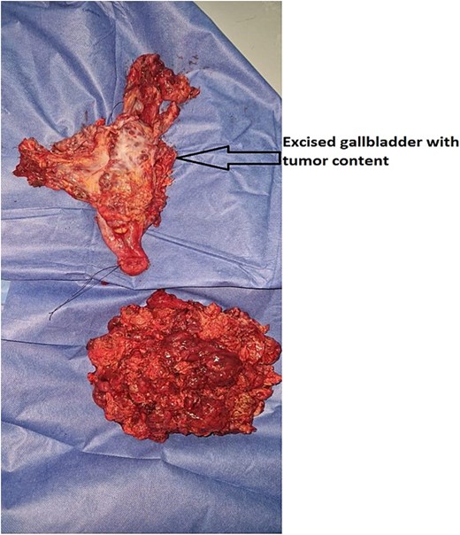 Surgical specimen following cholecystectomy, showing the excised gallbladder with undifferentiated carcinoma and tumor content. The specimen exhibits extensive tumor invasion with irregular, friable, and hemorrhagic tissue, consistent with an aggressive malignancy.