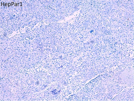 Histopathological section stained for HepPar-1, showing negative immunoreactivity in tumor cells.