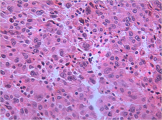 Hematoxylin and eosin (H&E) staining of the gallbladder tumor showing highly pleomorphic tumor cells with abundant eosinophilic cytoplasm, prominent nucleoli, and frequent mitotic figures, consistent with undifferentiated carcinoma.