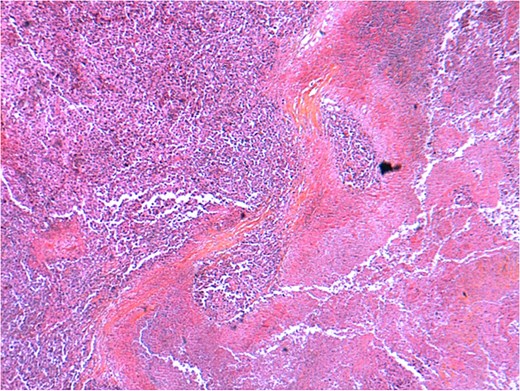 Histopathological examination of the gallbladder tumor (H&E stain) showing a highly undifferentiated carcinoma with extensive necrosis and inflammatory infiltrates. The tumor exhibits irregular architecture with areas of stromal reaction and vascular invasion.