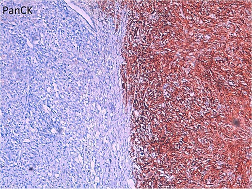 Immunohistochemical staining for Pan-Cytokeratin (PanCK) demonstrating strong positivity in the carcinoma cells (brown staining), highlighting their epithelial origin. The left side of the image shows a negative-staining area, possibly representing tumor necrosis or nonepithelial components.