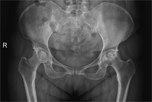 A radiograph was obtained preoperatively of a 47-year-old woman with bilateral avascular necrosis and collapse.